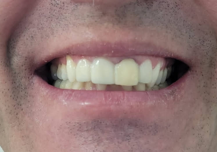 Harmonização do Sorriso antes