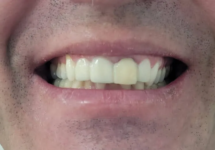 Harmonização do Sorriso antes
