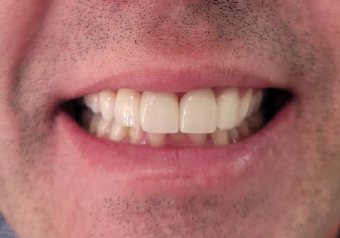 Harmonização do Sorriso depois