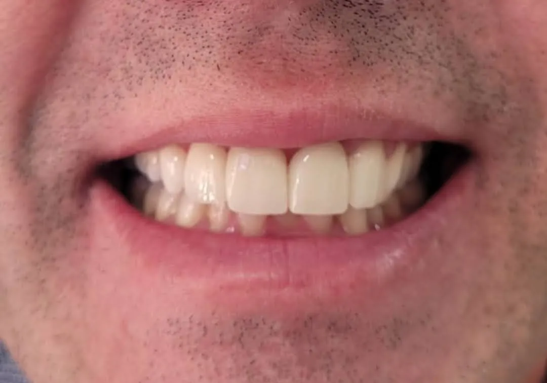 Harmonização do Sorriso depois